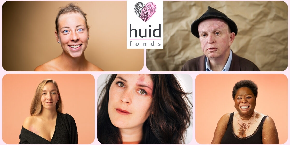 Huidfonds